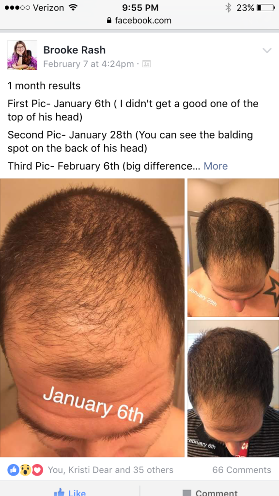 B4 After Pic of Man's Hair Returning